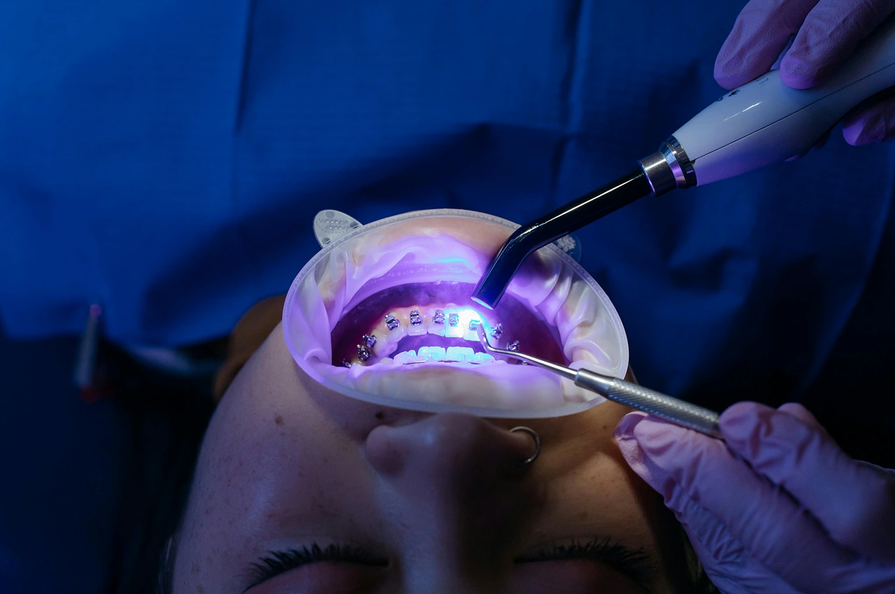 Orthodontic Braces new-1-img